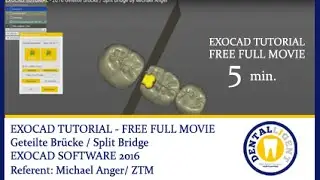 EXOCAD TUTORIAL - 2016 Geteilte Brücke / Split Bridge by Michael Anger