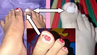 #Ingrown #IngrownaToenail #Remedy MY INGROWN TOENAIL STORY ( WATCH THIS! )