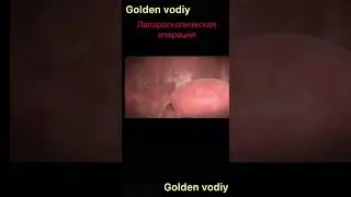 Лапароскопия