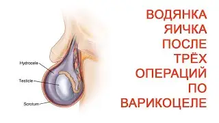 Hydrocele of the testicle after three operations for varicocele / Doctor Cherepanov