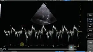 Tissue Doppler Step by Step - Medial e' Example