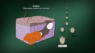 Scabies