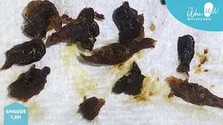 1,311 - Ears Brimming with Ear Wax Cleaned