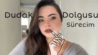 I Had Lip Fillers😍 How was the process? Details in the video! 