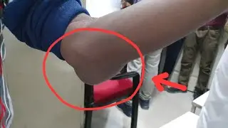 Student's Elbow Patient