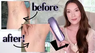 I tried laser hair removal at home... this is what happened...
