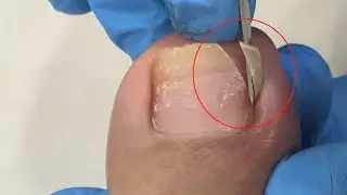 The danger of the front end of the toenail is finally solved!【TD Foot care】