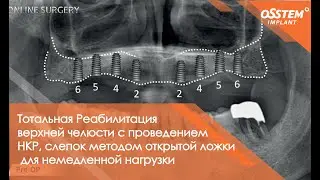 Тотальная Реабилитация верхней челюсти с проведением НКР, слепок методом открытой ложки