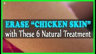 Get Rid Of "Chicken Skin” With 6 Natural Keratosis Pilaris Treatments | Best Home Remedies
