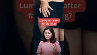 Lumpy Butt | Hip Fat Grafting | Lumps After BBL | Lumps After Fat Transfer | SB Aesthetics