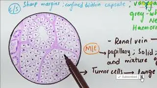 Histopathology of Renal Cell Carcinoma