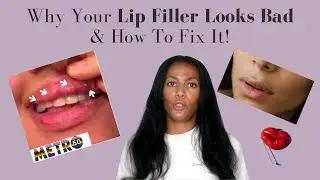 What Makes Lip Filler Look Bad | How To Fix Lip Filler Problems | Top Lip Filler Tips