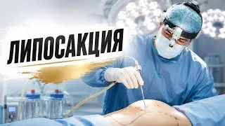 Немного о липосакции