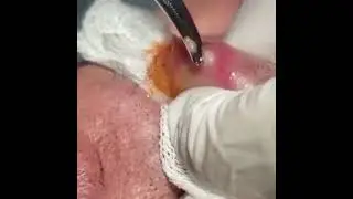 Удаление личинки мухи из губы