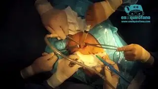 Drenaje de Seroma mamario