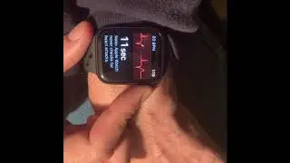 Premature Ventricular Contractions