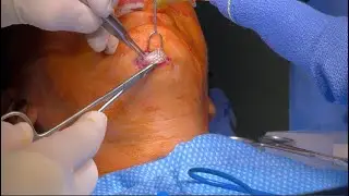 Surgical removal of silicone chin implant.