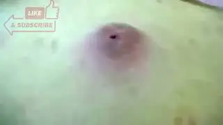 creamy pimple poping