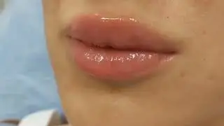 Меди-Лайт. Коррекция губ филлером.