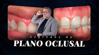 Transforme Tratamentos com o Plano Oclusal! 😏