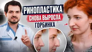 Ринопластика//снова выросла горбинка