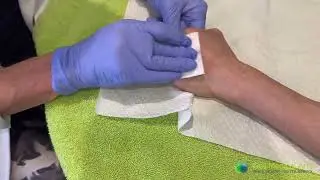 Hand Rejuvenation with dermal filler using Bellafill at Well Medical Arts in Seattle