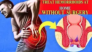 6 Natural Ways to treat hemorrhoids Quickly And Effectively |Treat Piles At Home |Home Remedy