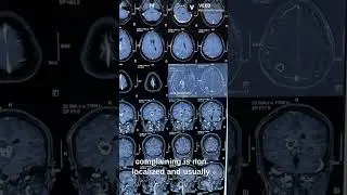 MRI Brain case Discussion #mrcp #doctor