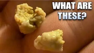 Watson Discovers Nose Stones!  What Are They?