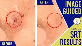 Image-Guided SRT Results | Mohs Surgery Alternative | Haber Dermatology