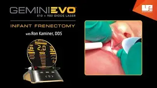 Infant Frenectomy | Gemini EVO™ clinical cases
