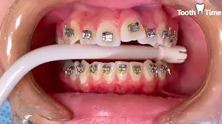 How they put Braces on - 13 years old patient - Tooth Time Family Dentistry New Braunfels Texas