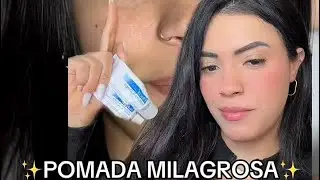 ✨Pomada MILAGROSA que tira manchas de espinhas