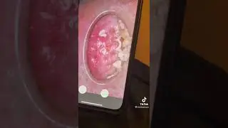 Nose pimple