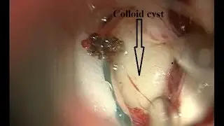 Colloid Cyst  foramen monro transcallosal approach 699573