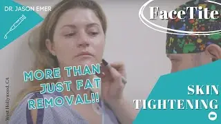FaceTite SCULPTED JAWLINE: More Than Just Fat Removal -- Facial Skin Tightening LIPO | DR JASON EMER