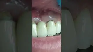 КЕРАМИКА ТИШЛАР АТРОФИДА МИЛК КОЧСА НИМА КИЛИШ КЕРАК ?! +79636579707 ВАТСАП