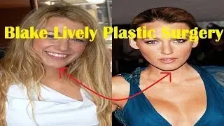 Blake Lively Plastic Surgery Before and After HD