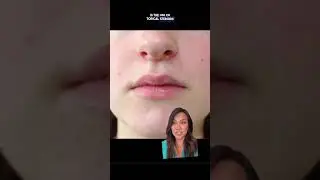 Even celebrities like Hailey Bieber deal with skin conditions like perioral dermatitis!