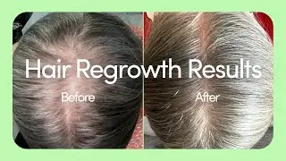Minoxidil Results: Hers Hair Before and Afters