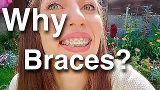 Braces or Invisalign? Which one to choose and having 4 teeth removed