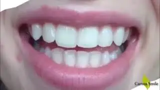 Como deixar Seus Dentes Brancos em 6 dias - Carvox Smile