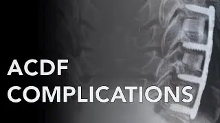 FUSED EP 6: ACDF Complications