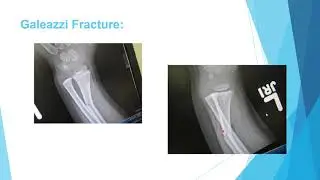 pediatric trauma 4 (upper extremity)