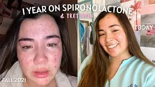 How I cleared my acne | 1 year on spironolactone & tretinoin update