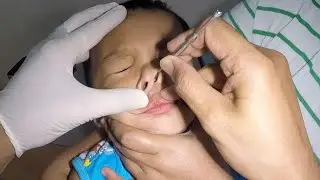 Something Hard Stuck in Boy's Nose Removal | What is  It?