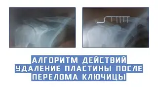 Алгоритм действий  - Удаление пластины после перелома ключицы
