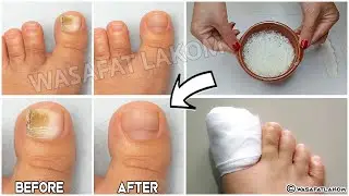Do you suffer from nail fungus? You have to do this!!!! *** VERY IMPORTANT TIP ***