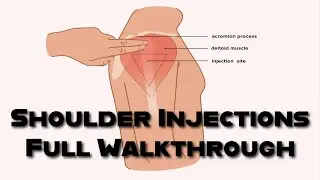 Intramuscular Injections into the Arm (Deltoid): A Step-by-Step Guide