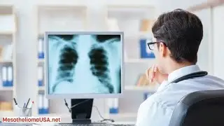 BAP1 Sarcomatoid Mesothelioma - What Is Your Approach To Sarcomatoid Mesothelioma Patients?